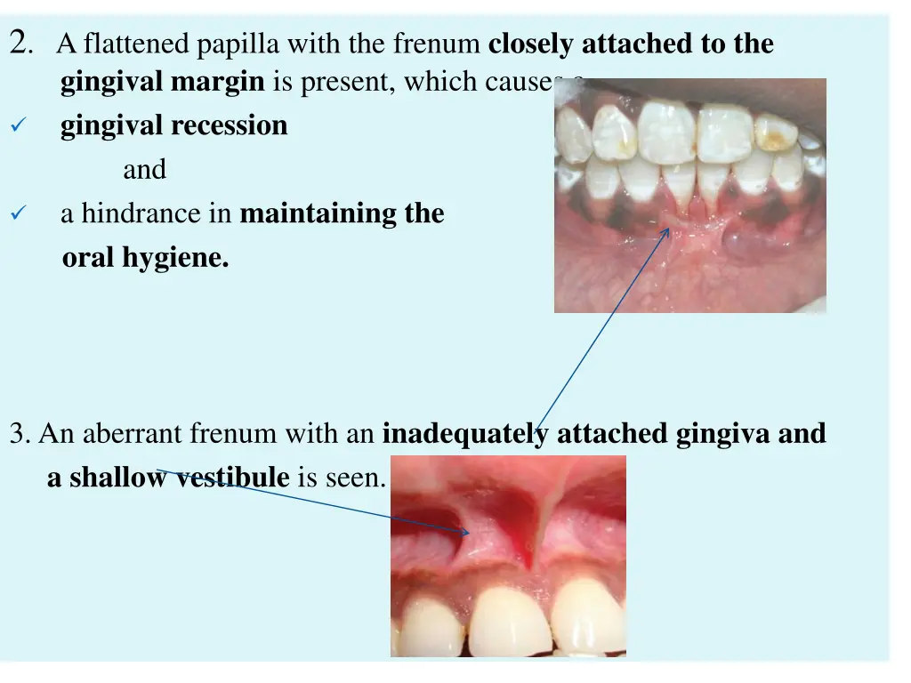 2 a flattened papilla with the frenum closely