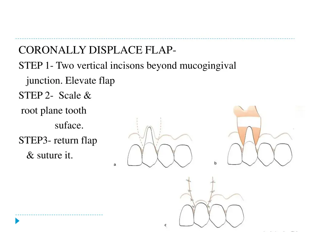 coronally displace flap step 1 two vertical