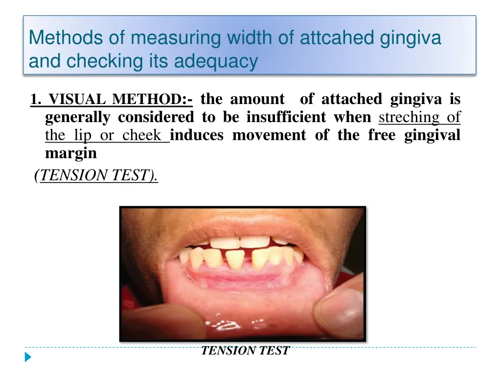 methods of measuring width of attcahed gingiva