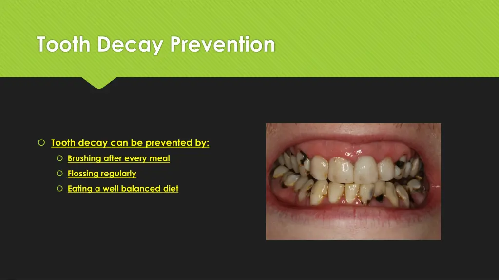 tooth decay prevention