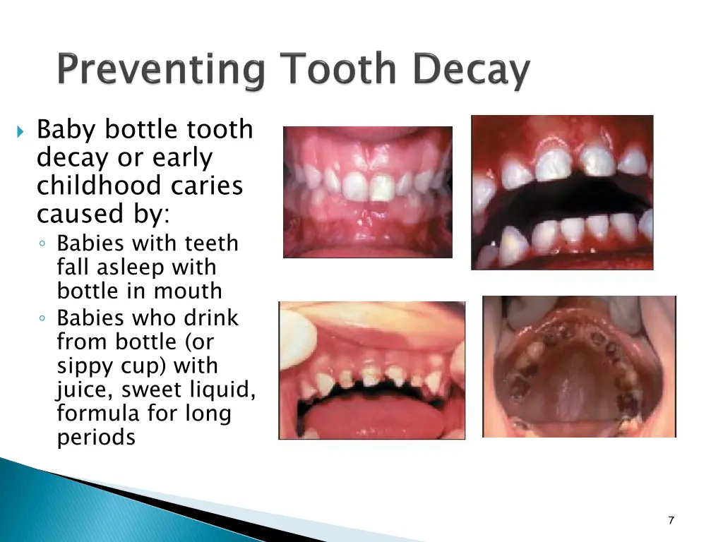 baby bottle tooth decay or early childhood caries