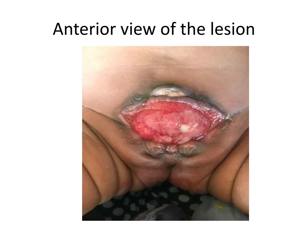 anterior view of the lesion