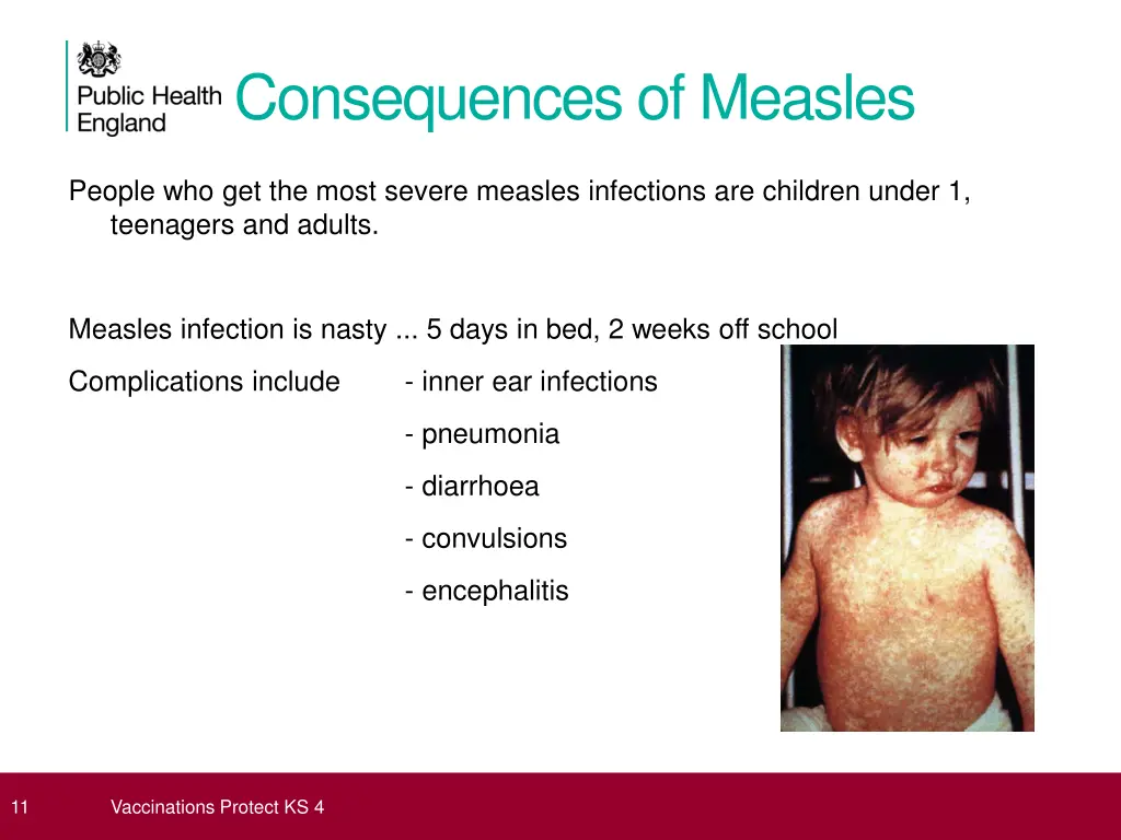 consequences of measles