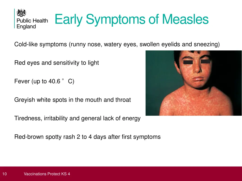 early symptoms of measles