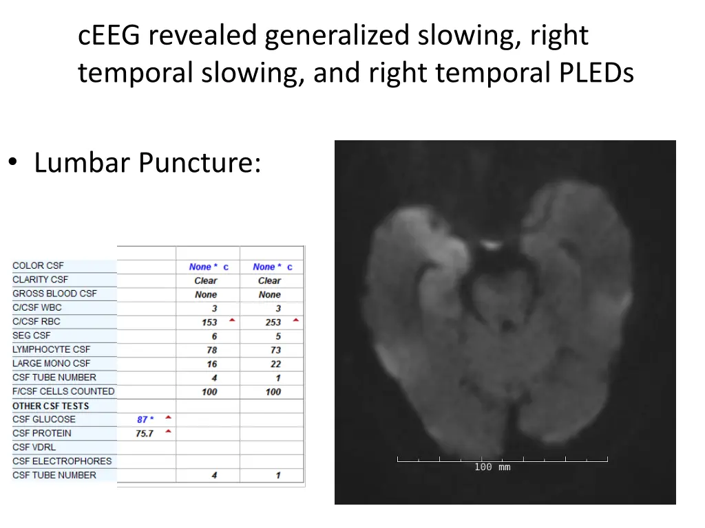 ceeg revealed generalized slowing right temporal