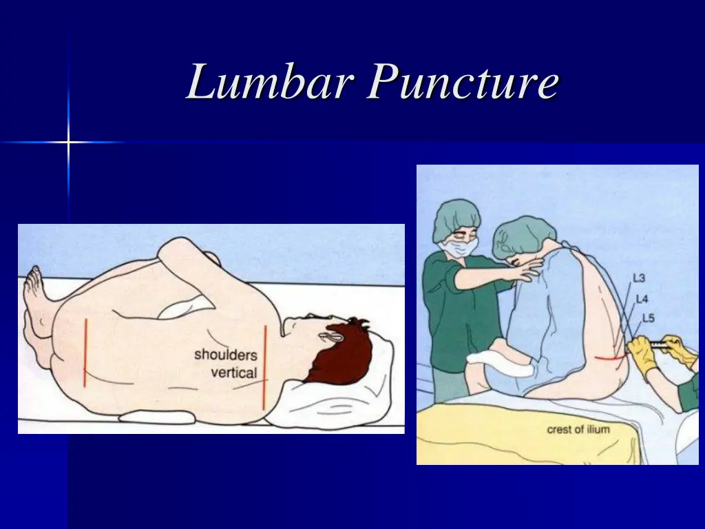 lumbar puncture 7