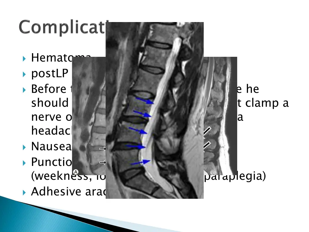 hematoma postlp headache before the doctor