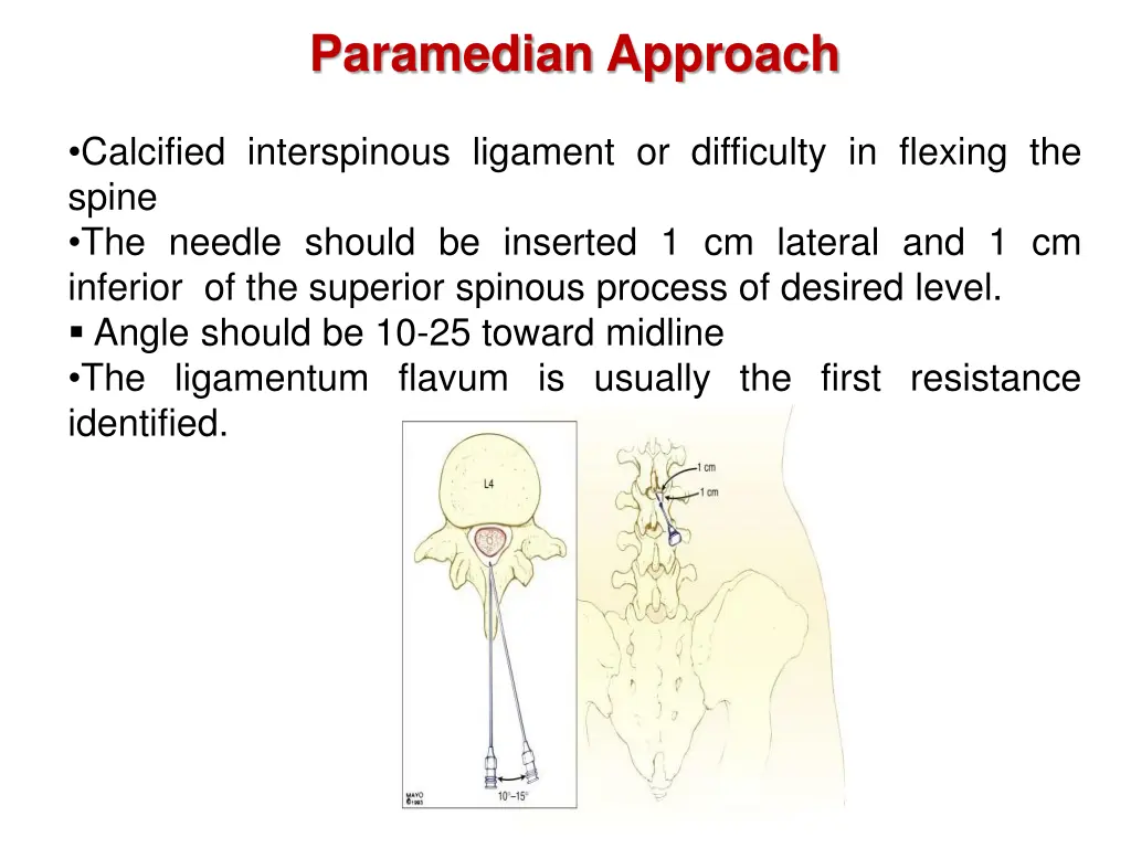 paramedian approach