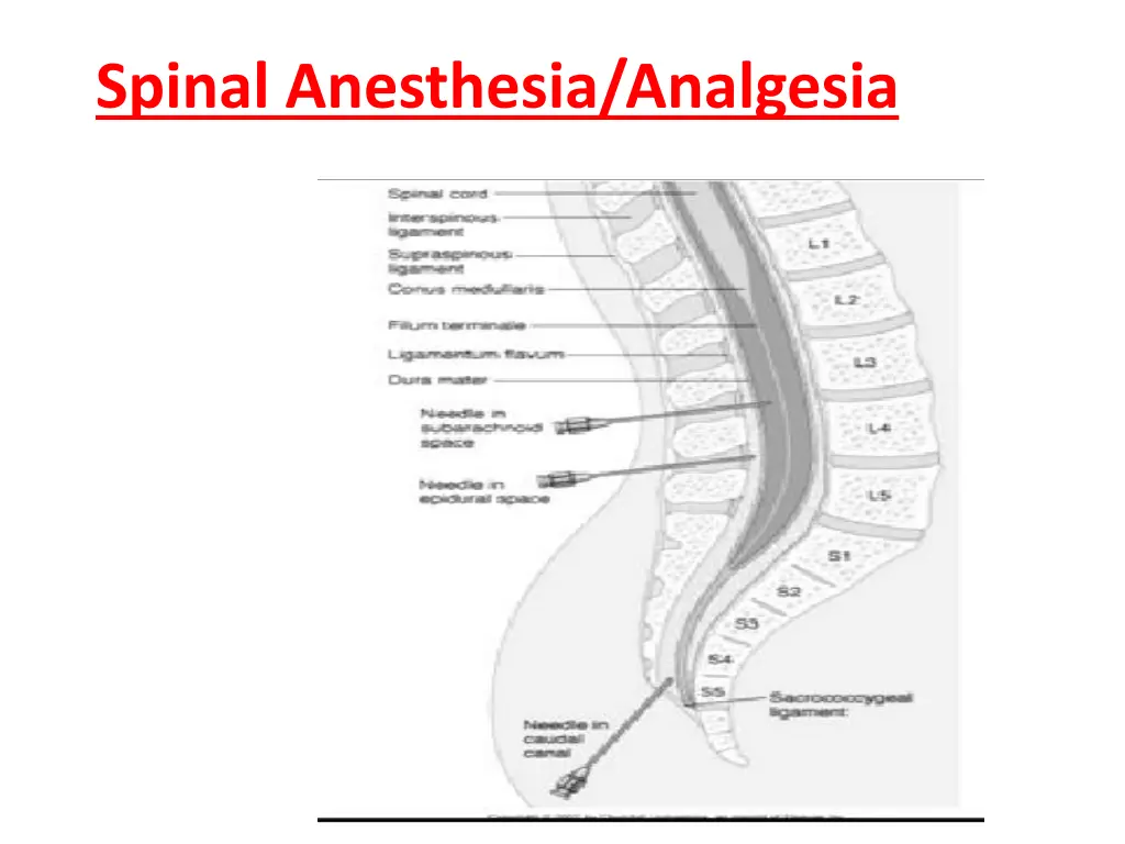 spinal anesthesia analgesia