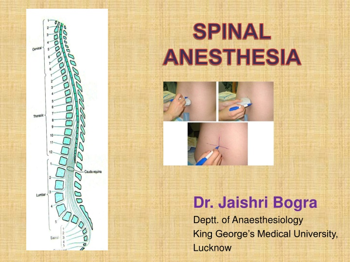 spinal anesthesia