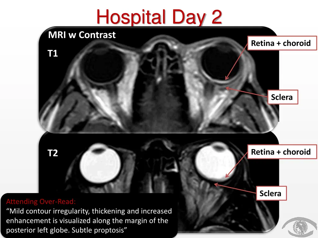 hospital day 2 mri w contrast