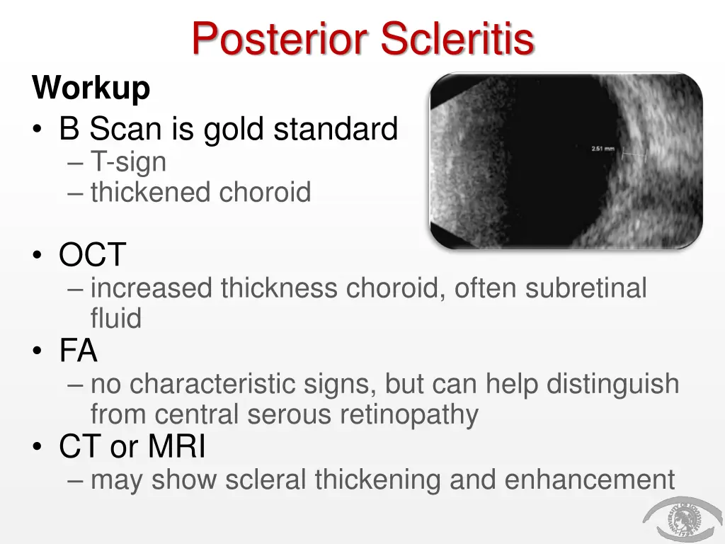 posterior scleritis 2