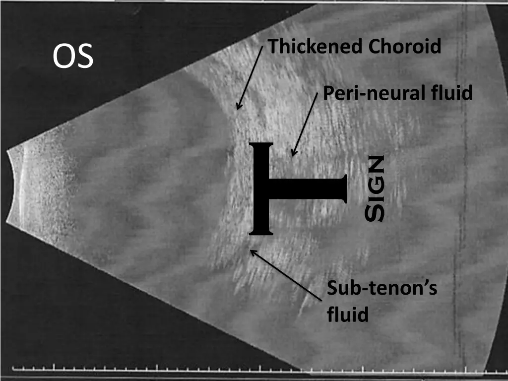 thickened choroid