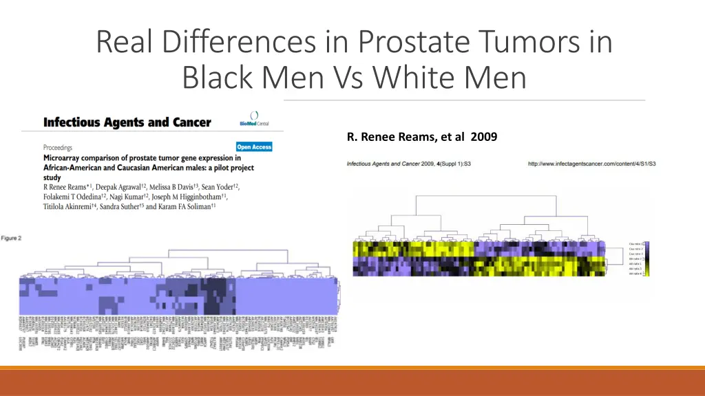 real differences in prostate tumors in black