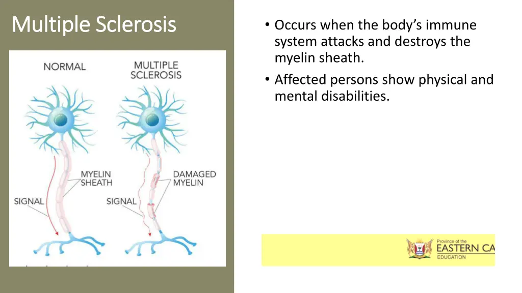 multiple sclerosis multiple sclerosis