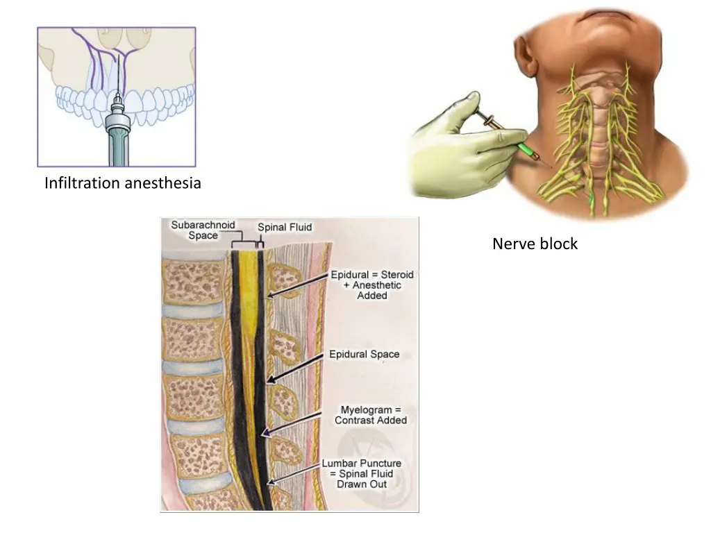 infiltration anesthesia