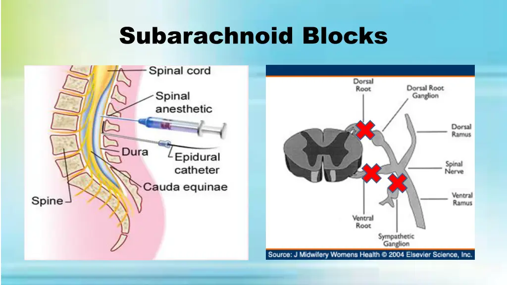 subarachnoid blocks