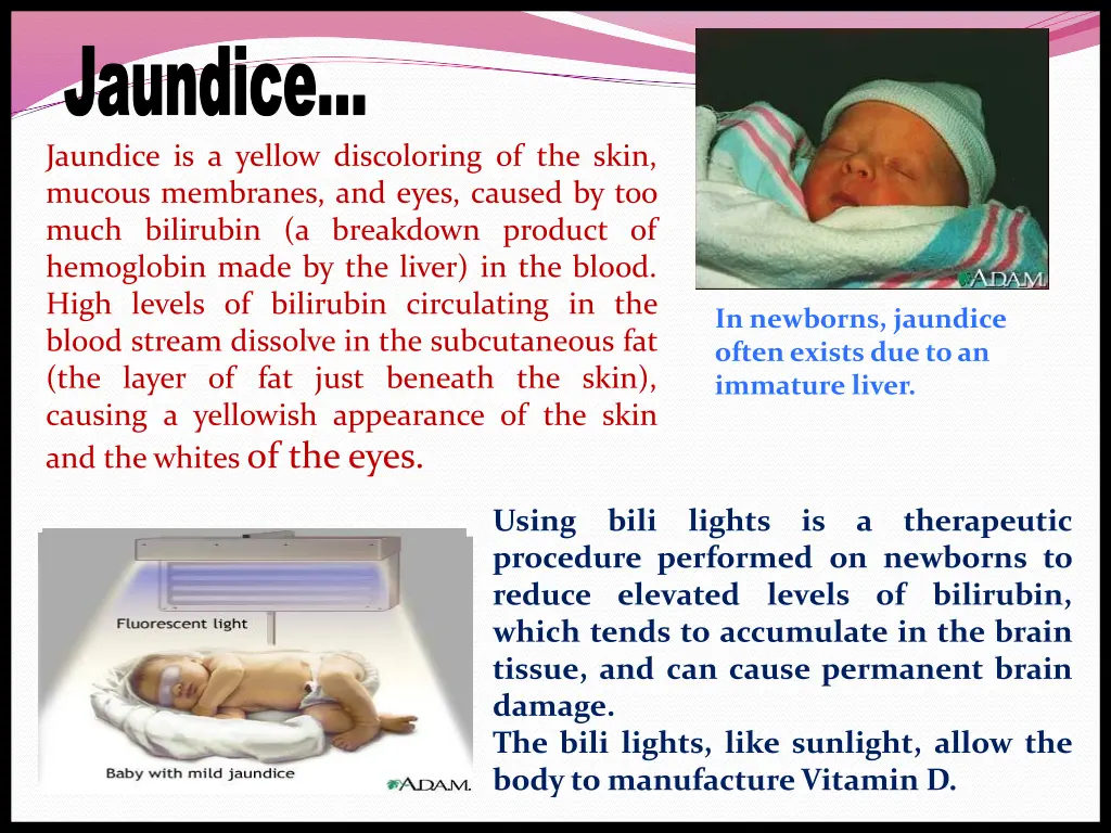 jaundice