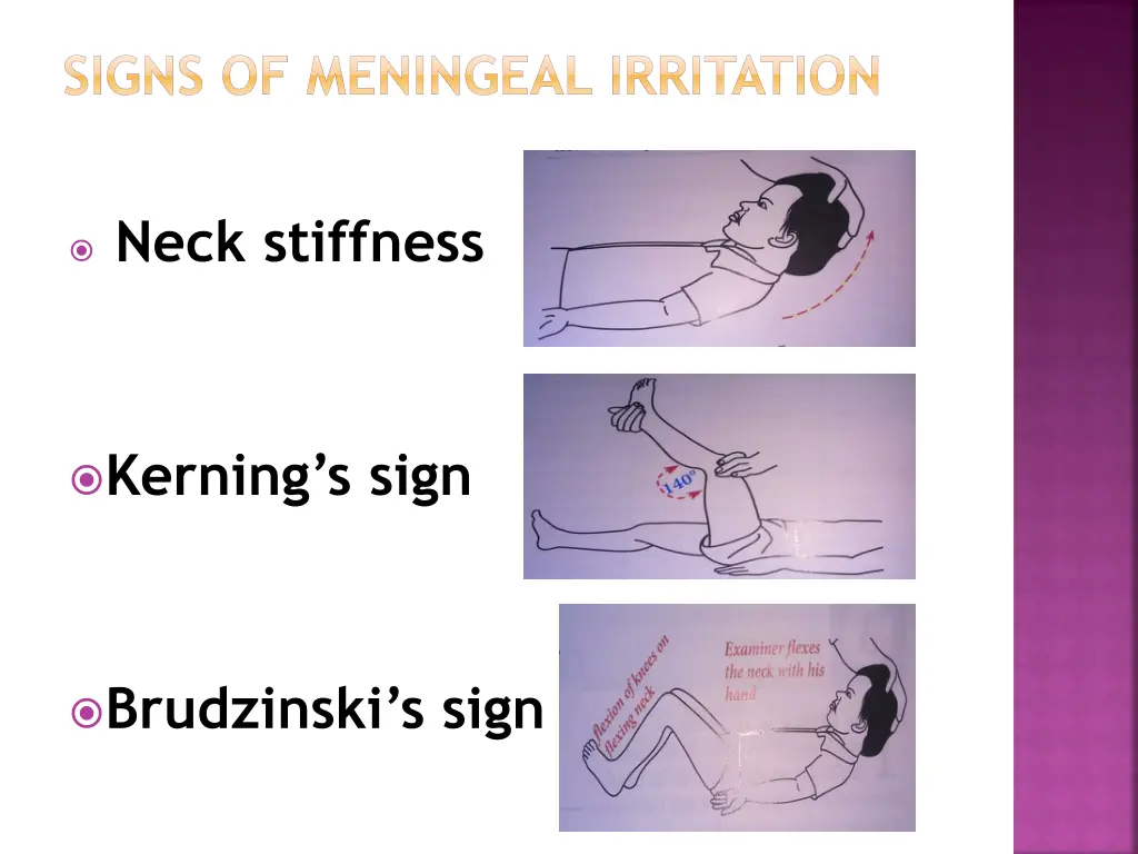 signs of meningeal irritation