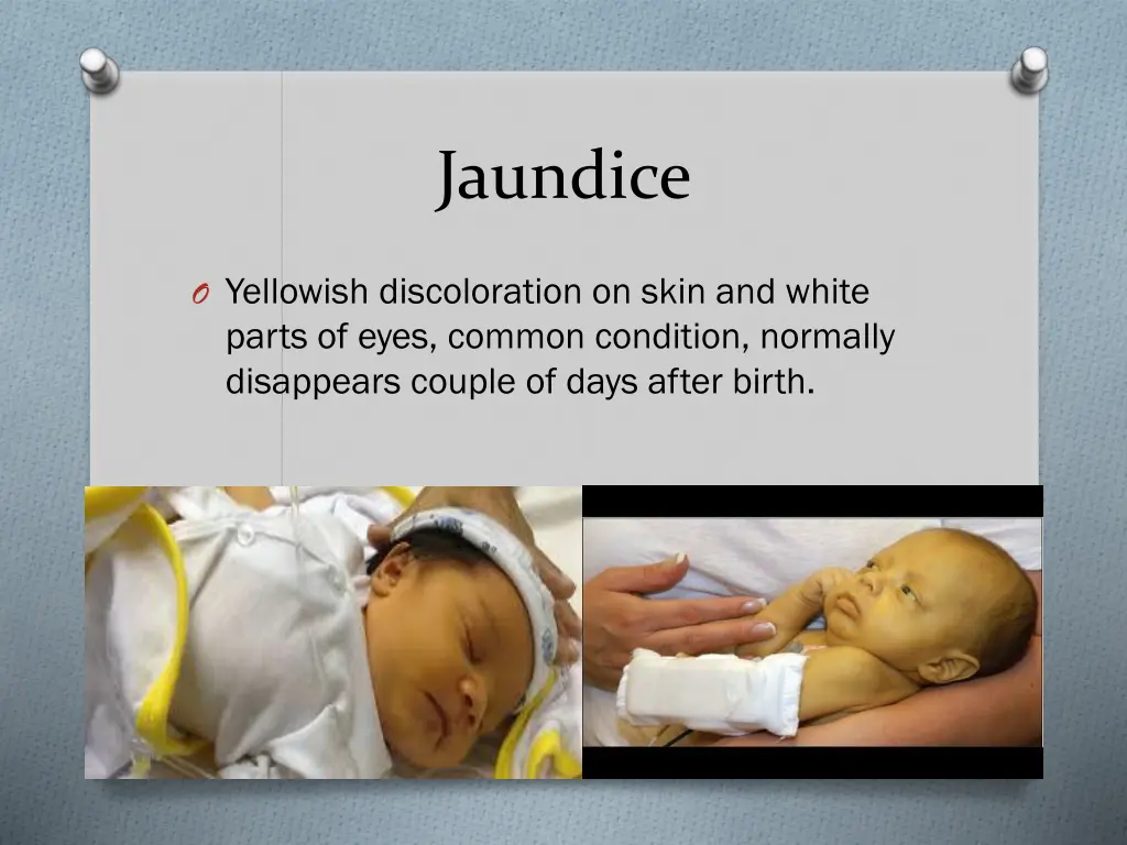 jaundice