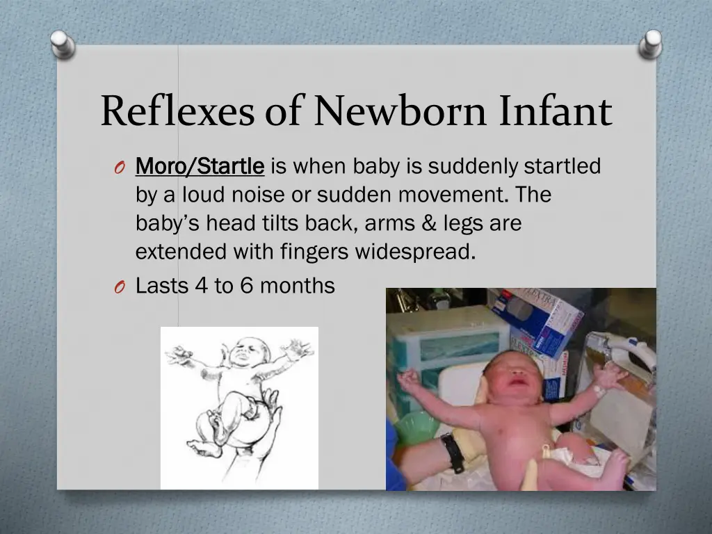 reflexes of newborn infant 2