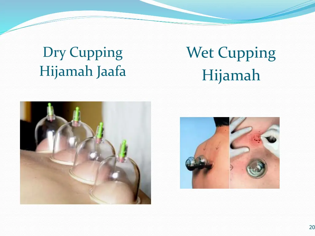 wet cupping hijamah