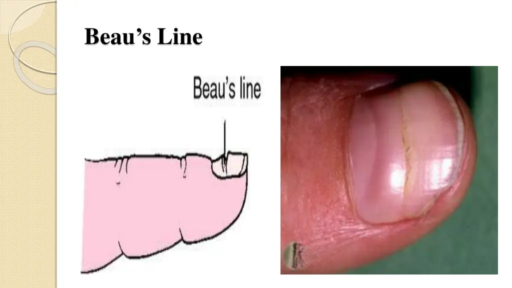 beau s line