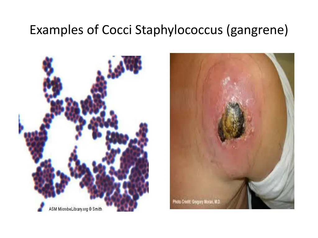 examples of cocci staphylococcus gangrene