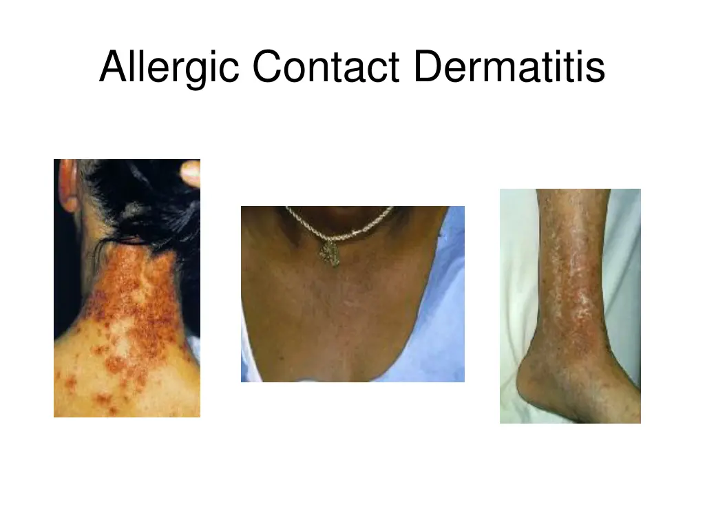 allergic contact dermatitis 2