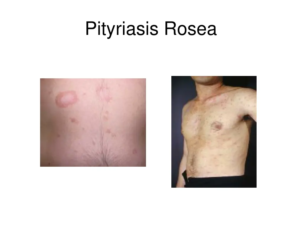 pityriasis rosea 2