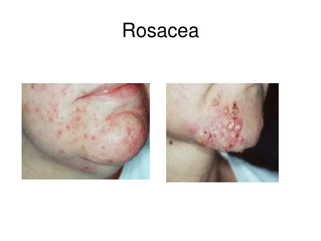 rosacea 2