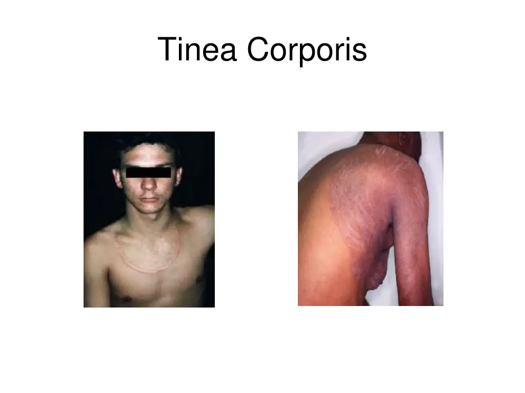 tinea corporis 3