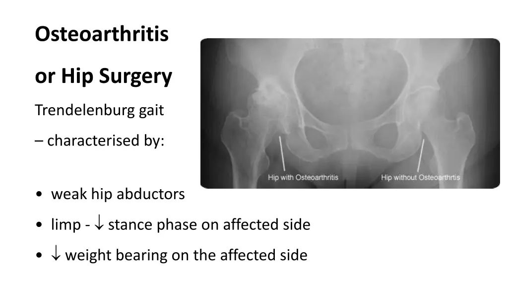 osteoarthritis