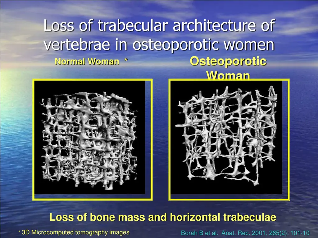 loss of trabecular architecture of vertebrae