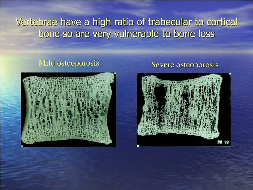 vertebrae have a high ratio of trabecular