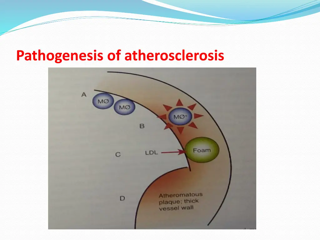 pathogenesis of atherosclerosis