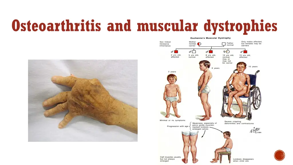 osteoarthritis and muscular dystrophies