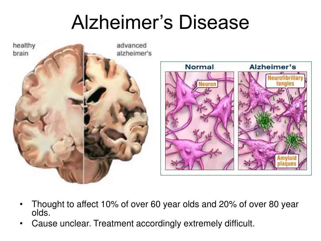 alzheimer s disease