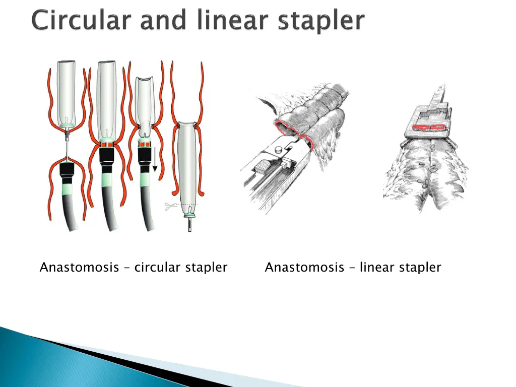 anastomosis circular stapler