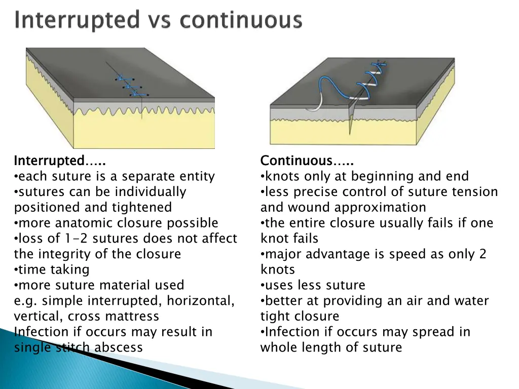 interrupted each suture is a separate entity