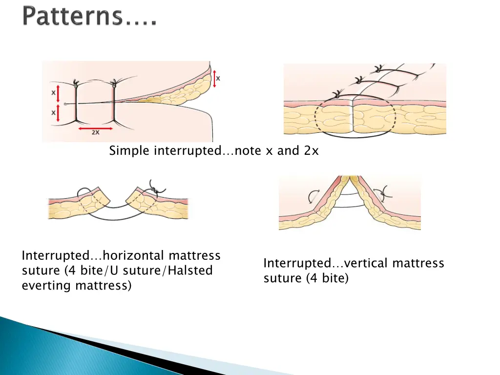 simple interrupted note x and 2x