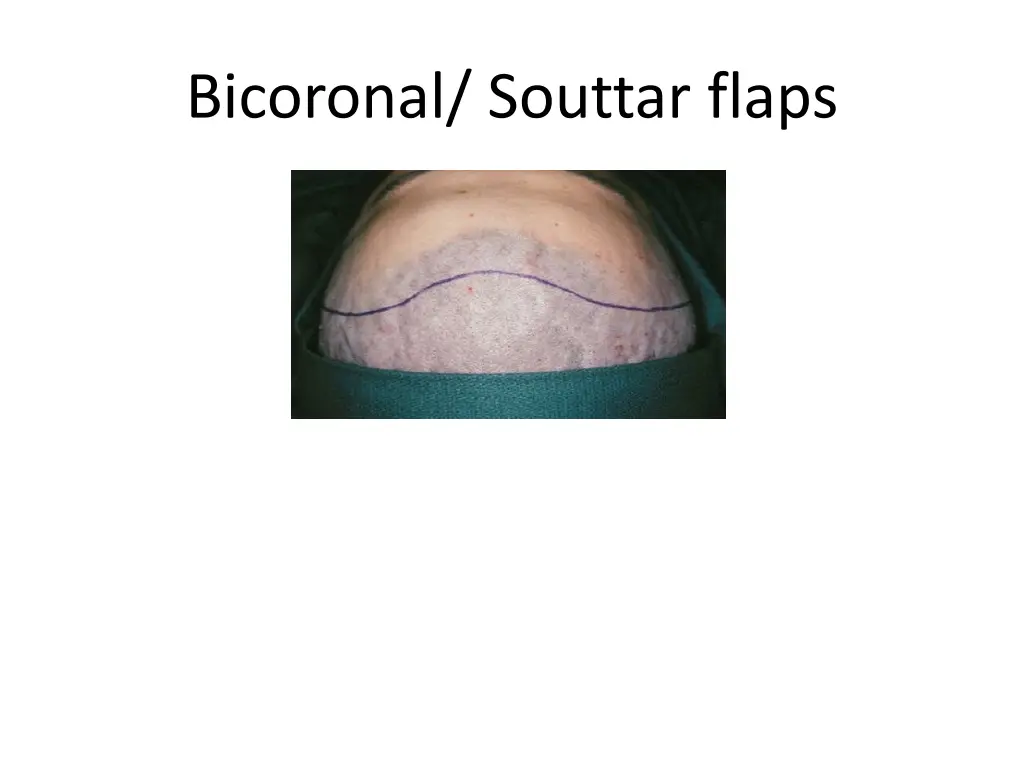 bicoronal souttar flaps