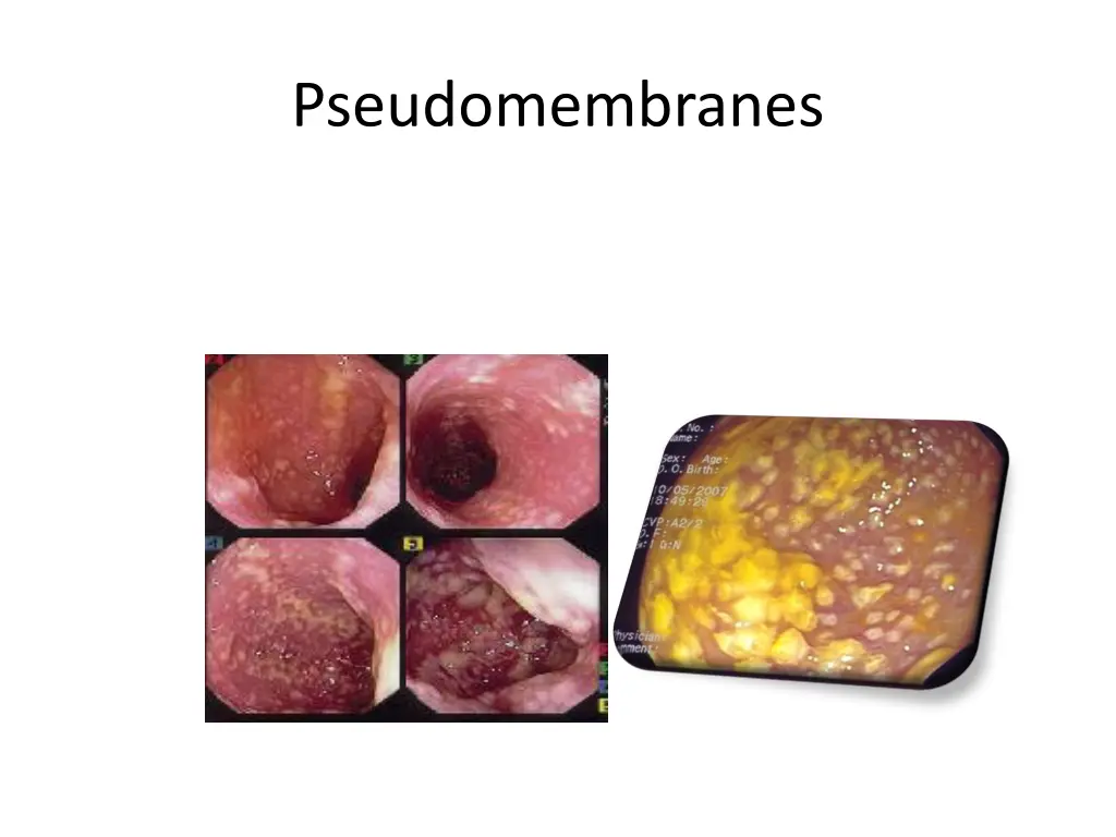 pseudomembranes