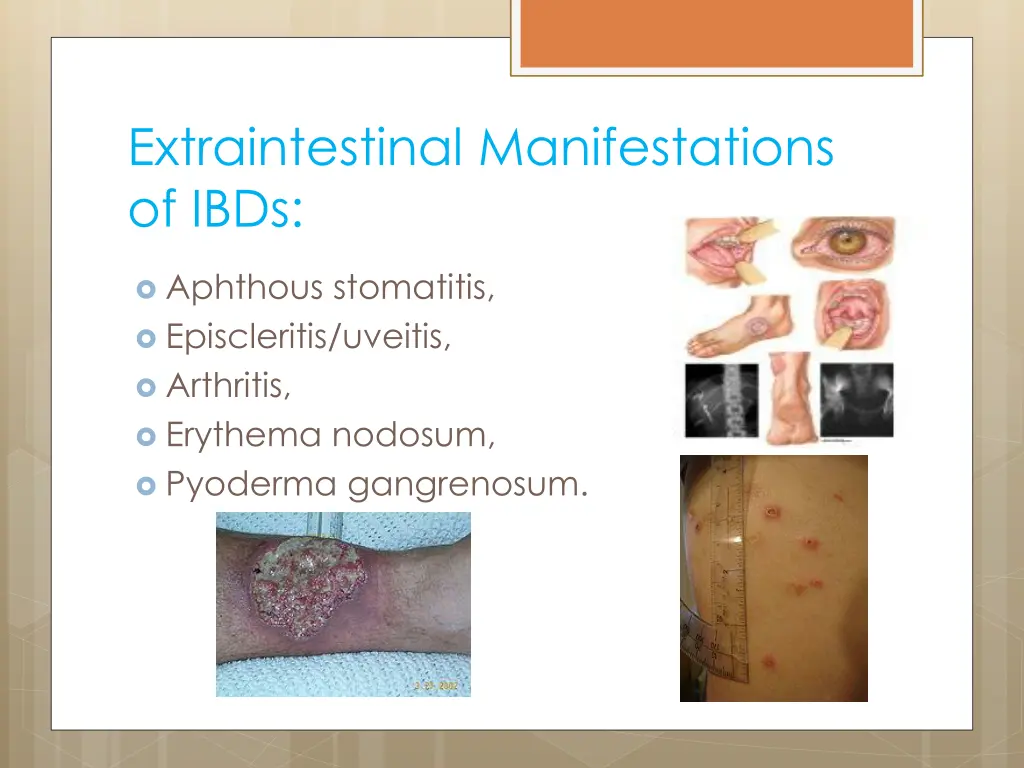 extraintestinal manifestations of ibds