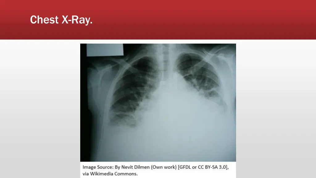 chest x ray