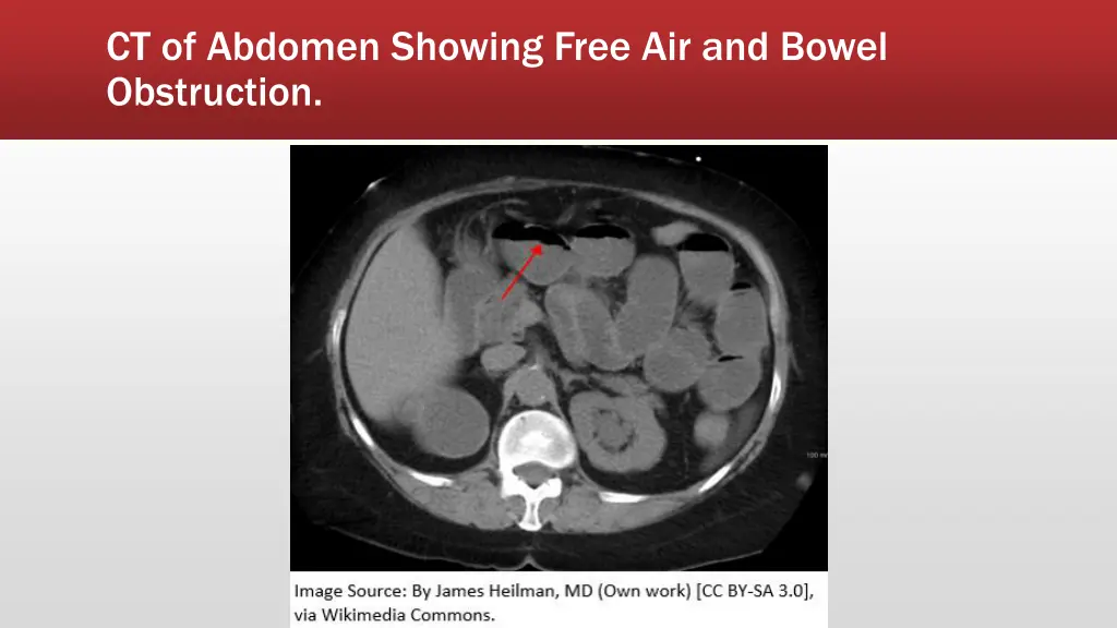 ct of abdomen showing free air and bowel