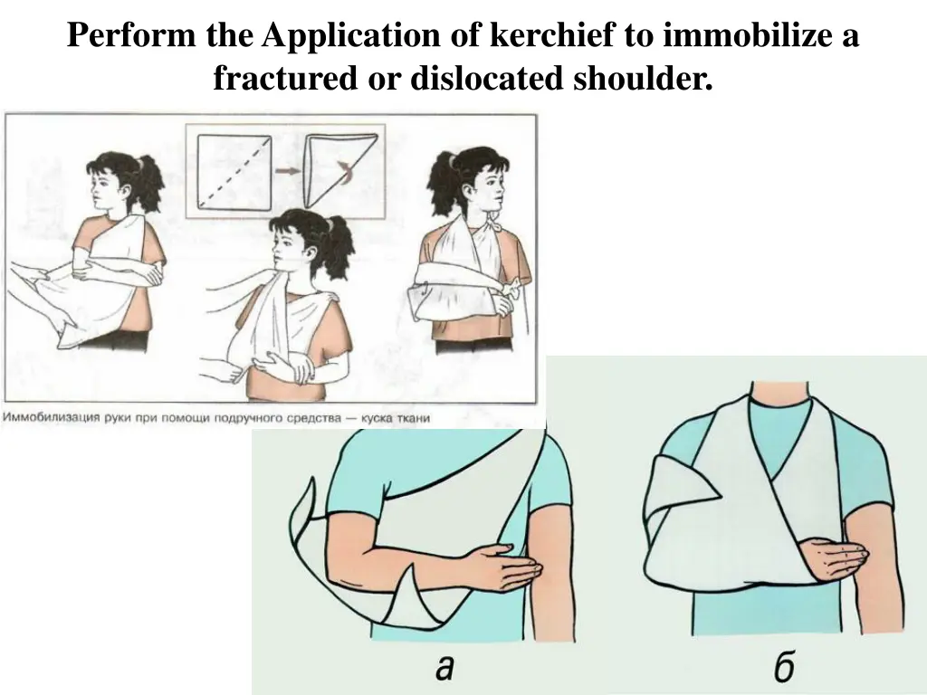 perform the application of kerchief to immobilize 1