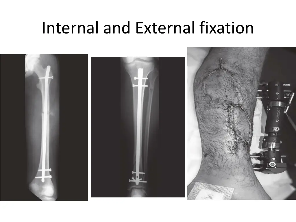 internal and external fixation