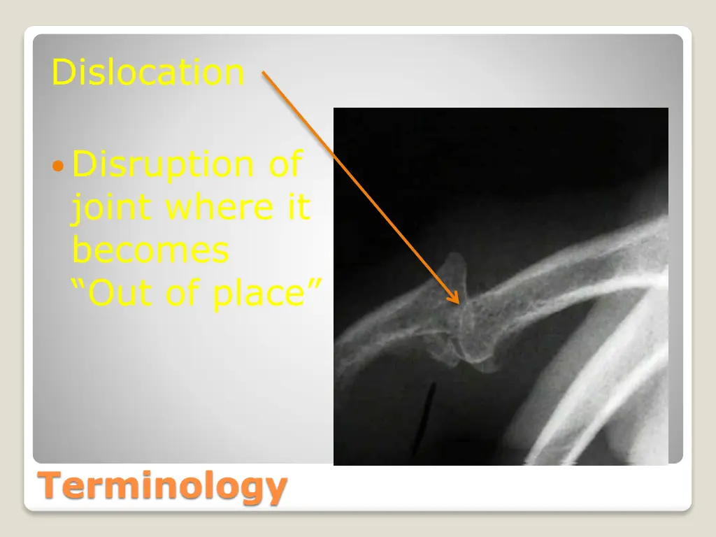 dislocation disruption of joint where it becomes