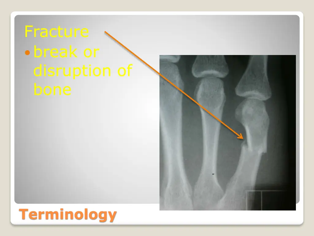 fracture break or disruption of bone